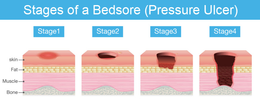 This is medical illustration of the Stages of a bed sore (Pressure Ulcer) of patient skin which extends from skin into muscles and bone.